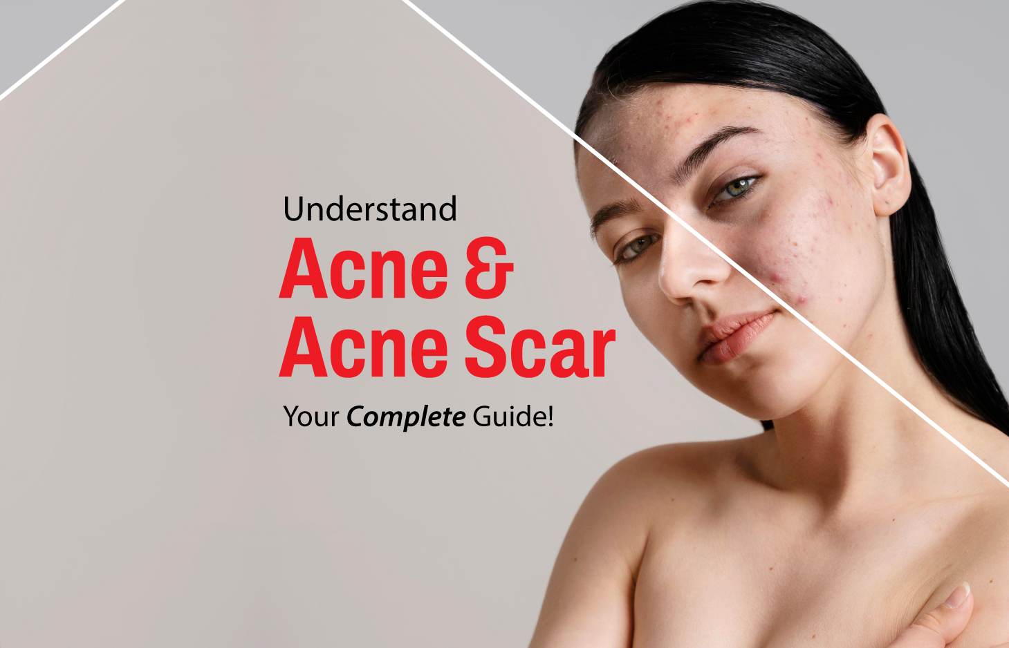 Read more about the article Understanding Acne and Acne Scars: Your Complete Guide
