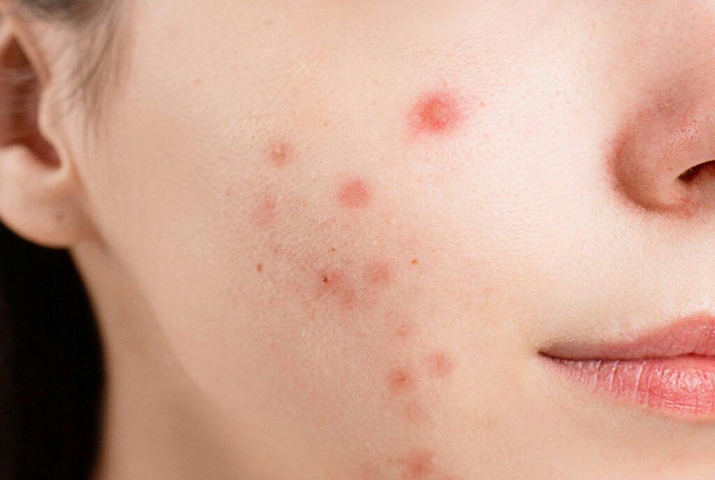 Woman receiving a chemical peel with a fan brush
