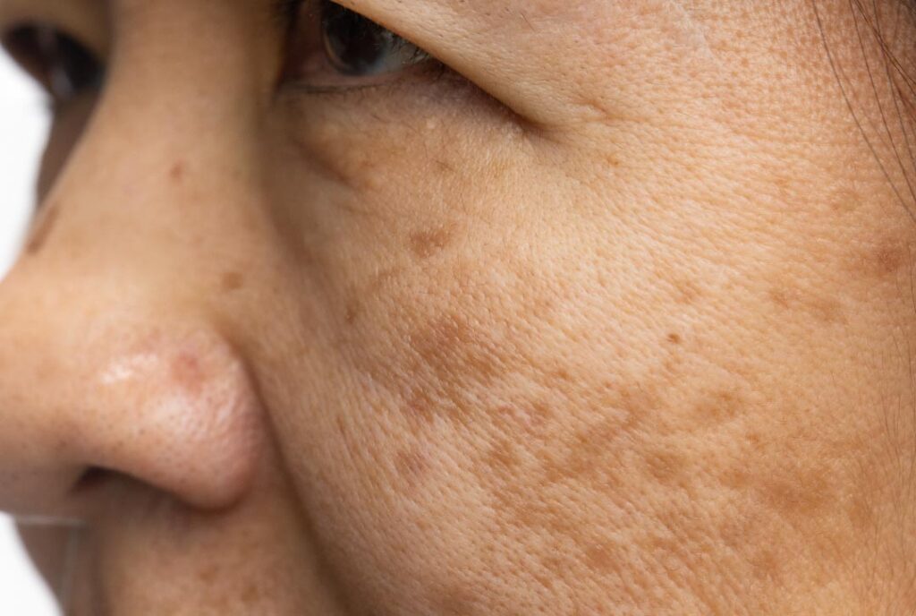 Woman with visible cheek pigmentation