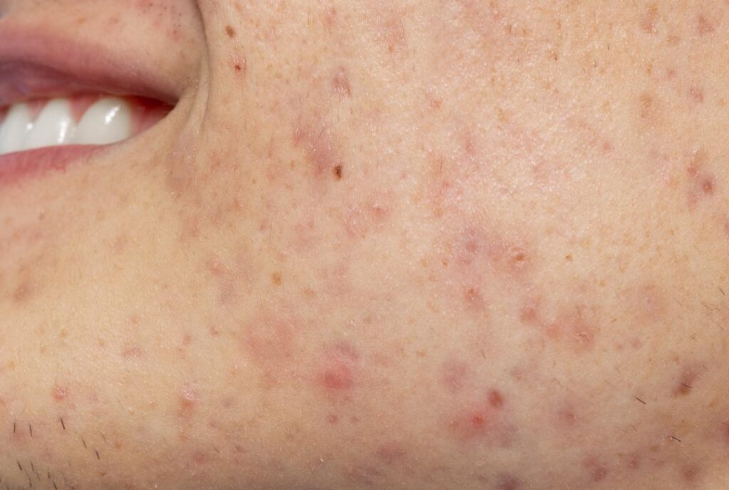 Man with acne scars and a magnified cheek detail